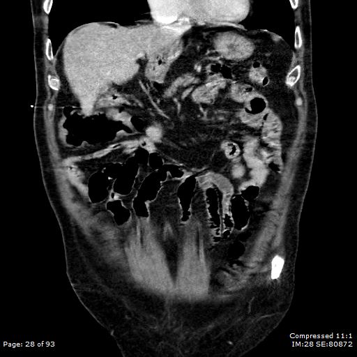 Adrenal metastasis (Radiopaedia 78425-91079 Sagittal C+ portal venous phase 15).jpg