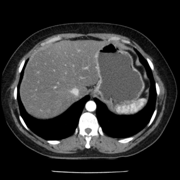 Adrenal myelolipoma (Radiopaedia 43401-46759 Axial C+ arterial phase 14).jpg