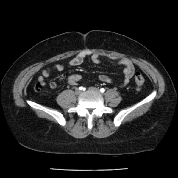 Adrenal myelolipoma (Radiopaedia 43401-46759 Axial C+ arterial phase 70).jpg