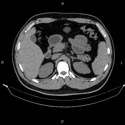 Adrenal myelolipoma (Radiopaedia 84321-99619 Axial non-contrast 37).jpg