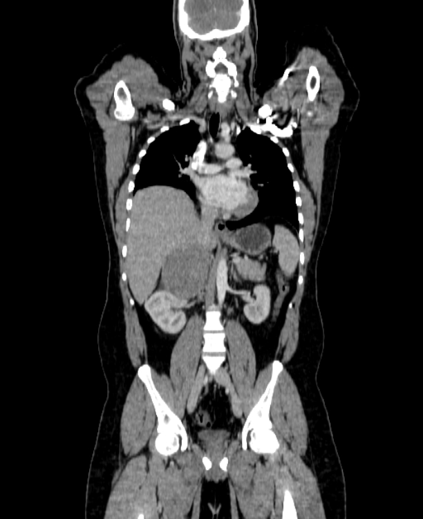 Adrenocortical carcinoma (Radiopaedia 80134-93438 Coronal C+ portal venous phase 91).jpg