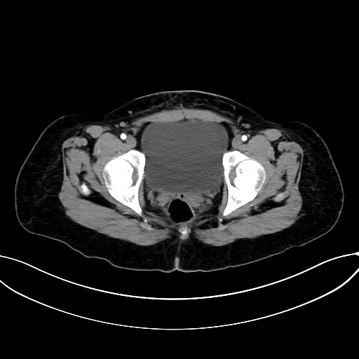 Adrenocortical carcinoma (Radiopaedia 87281-103569 Axial C+ arterial phase 83).jpg
