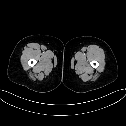 Adrenocortical carcinoma (Radiopaedia 87281-103569 Axial C+ portal venous phase 105).jpg