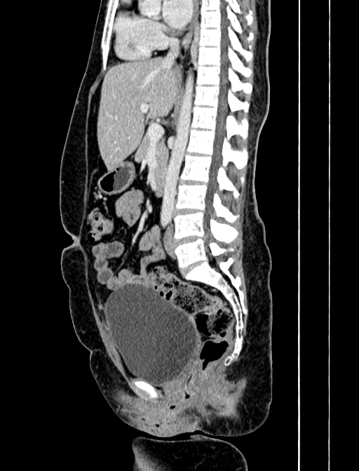 Adrenocortical carcinoma (Radiopaedia 87281-103569 Sagittal C+ portal venous phase 152).jpg
