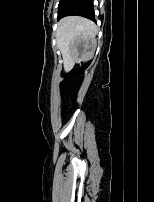 Adrenocortical carcinoma (Radiopaedia 87281-103569 Sagittal C+ portal venous phase 23).jpg