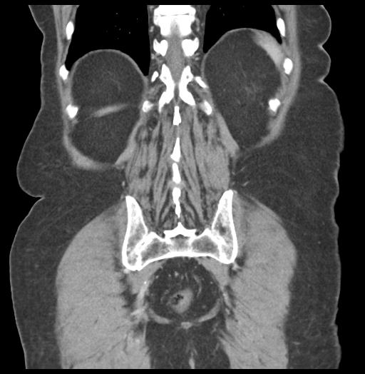 Adult ileal intussusception with secondary obstruction (Radiopaedia 30395-31051 Coronal C+ portal venous phase 51).jpg