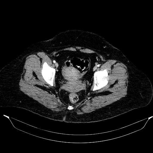 File:Afferent loop syndrome - secondary to incarcerated trocar site hernia (Radiopaedia 82959-97305 Axial C+ portal venous phase 214).jpg