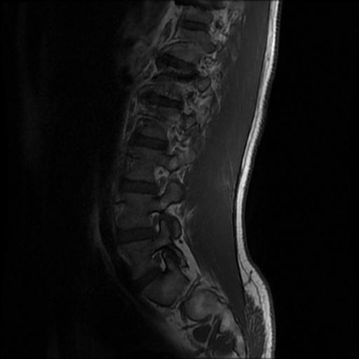 File:Aggressive vertebral hemangioma with pathological fracture (Radiopaedia 69528-79411 Sagittal T1 9).jpg