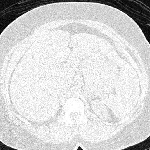 File:Air trapping in small airway disease (Radiopaedia 61685-69694 Axial lung window 207).jpg