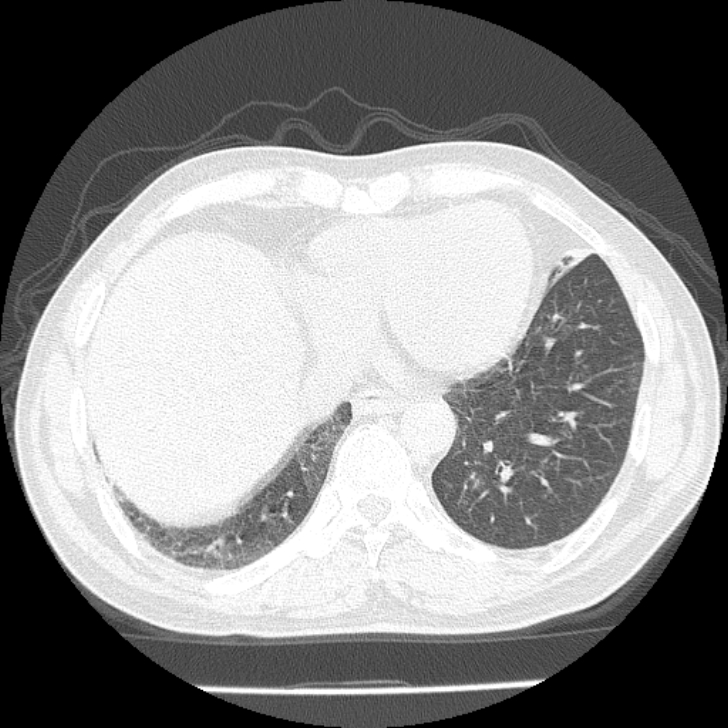 Airway foreign body in adult (Radiopaedia 85907-101779 Axial lung window 143).jpg