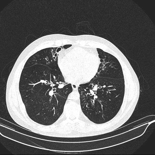File:Allergic bronchopulmonary aspergillosis (Radiopaedia 21386-21320 Axial lung window 24).jpg