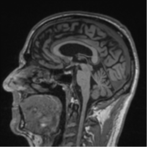 Alzheimer's disease- with Gerstmann syndrome and dressing apraxia (Radiopaedia 54882-61150 Sagittal T1 34).png
