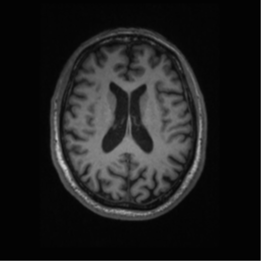 Alzheimer disease - probable (Radiopaedia 35334-36837 Axial T1 46).png