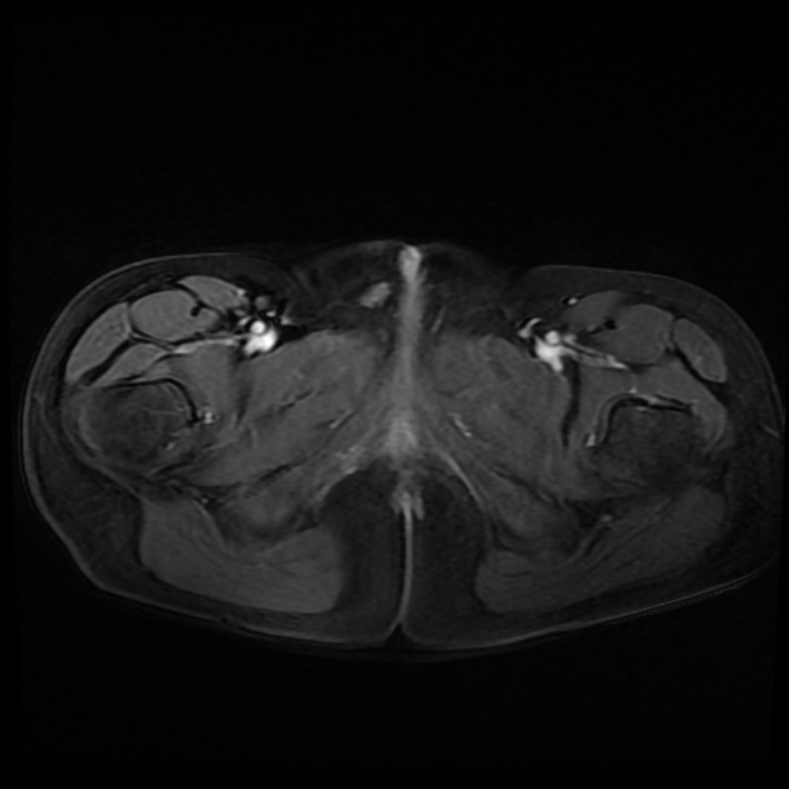 Ambiguous genitalia (Radiopaedia 69686-79643 Axial T1 C+ fat sat 51).jpg