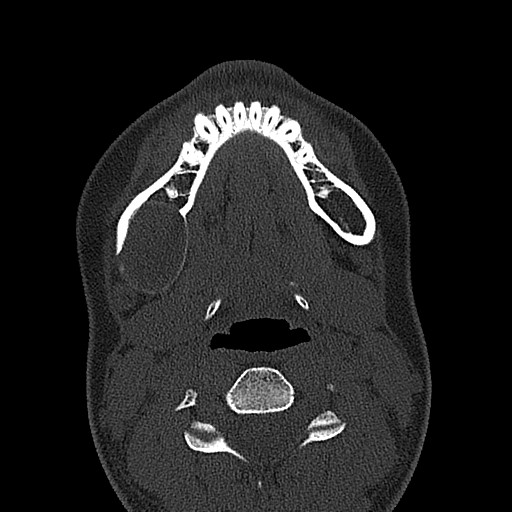 File:Ameloblastoma (Radiopaedia 26645-26793 E 21).jpg