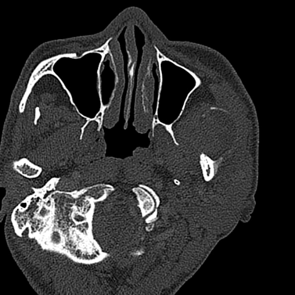 Ameloblastoma (Radiopaedia 51921-57766 Axial bone window 126).jpg
