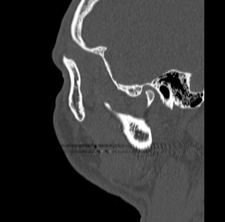 Ameloblastoma (Radiopaedia 77750-89997 Sagittal bone window 111).jpg