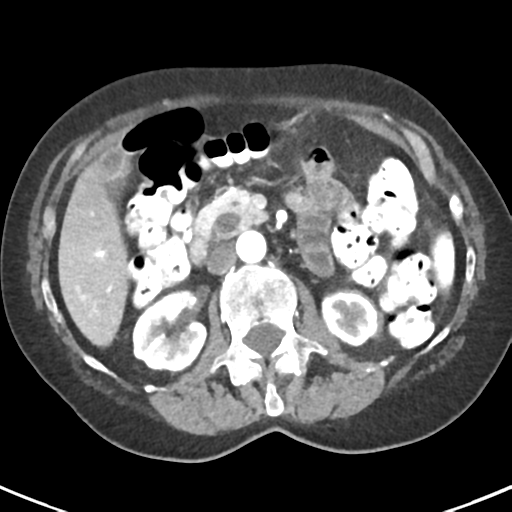 Ampullary adenocarcinoma (Radiopaedia 34013-35237 B 38).png