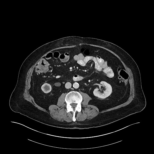 Ampullary adenocarcinoma (Radiopaedia 59373-66734 C 81).jpg