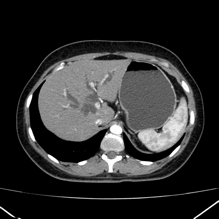 Ampullary tumor (Radiopaedia 22787-22816 B 20).jpg