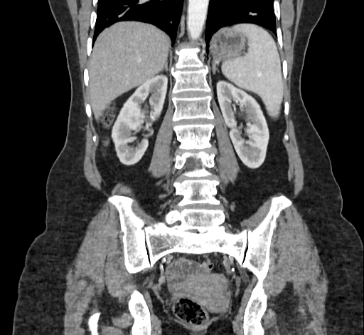 Ampullary tumor (Radiopaedia 60333-67998 B 54).jpg