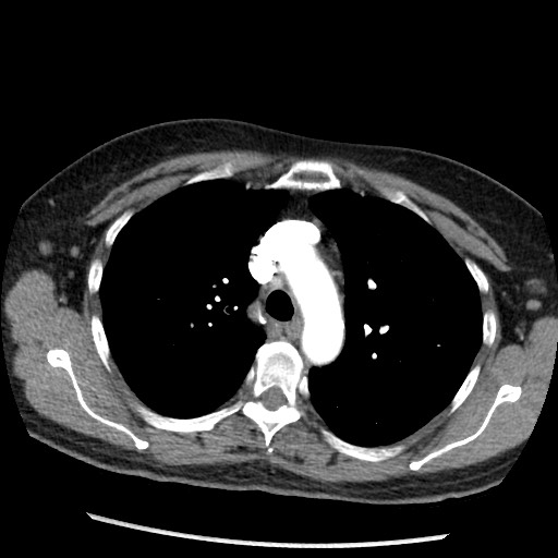 Amyloidosis - bronchial and diffuse nodular pulmonary involvement (Radiopaedia 60156-67745 A 16).jpg
