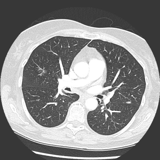 Amyloidosis - bronchial and diffuse nodular pulmonary involvement (Radiopaedia 60156-67745 Axial lung window 38).jpg