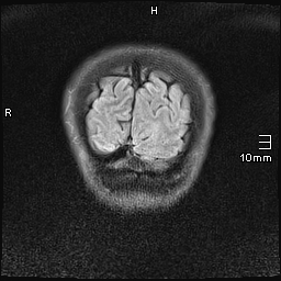 File:Amyotrophic lateral sclerosis (Radiopaedia 70821-81017 Coronal FLAIR 25).jpg