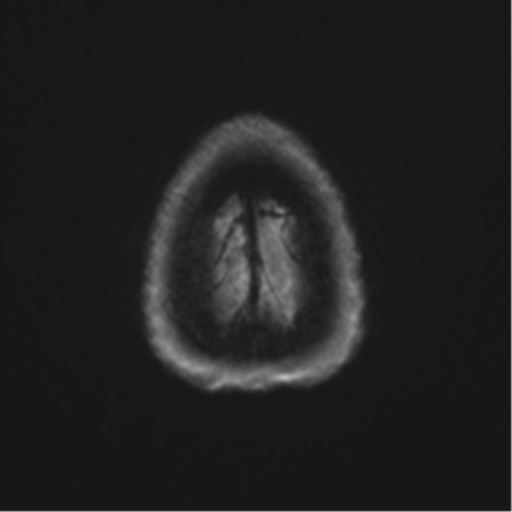 Anaplastic astrocytoma - thalamic glioma (Radiopaedia 59709-67115 Axial DWI 69).png