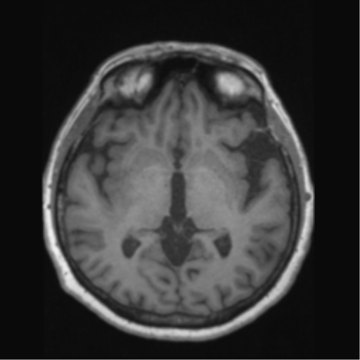Anaplastic astrocytoma IDH wild-type (pseudoprogression) (Radiopaedia 42209-45276 Axial T1 76).png