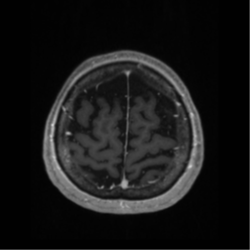 File:Anaplastic astrocytoma IDH wild-type (pseudoprogression) (Radiopaedia 42209-45276 Axial T1 C+ 125).png