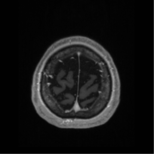 File:Anaplastic astrocytoma IDH wild-type (pseudoprogression) (Radiopaedia 42209-45276 Axial T1 C+ 132).png