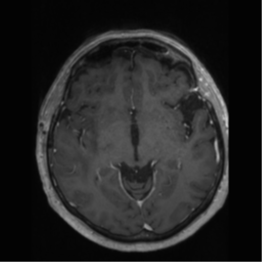 File:Anaplastic astrocytoma IDH wild-type (pseudoprogression) (Radiopaedia 42209-45277 Axial T1 C+ 55).png
