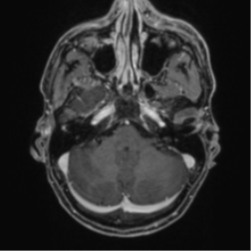 Anaplastic oligodendroglioma with skull fracture (Radiopaedia 74831-85845 Axial T1 C+ fat sat 10).png