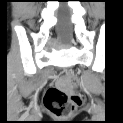 File:Aneurysmal bone cyst - sacrum (Radiopaedia 65190-74195 D 7).jpg