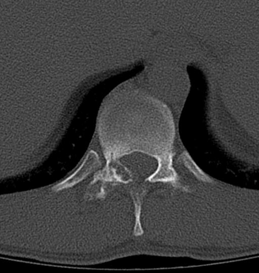 File:Aneurysmal bone cyst T11 (Radiopaedia 29294-29721 Axial bone window 39).jpg