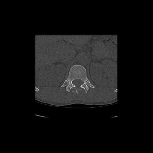 File:Aneurysmal bone cyst T11 (Radiopaedia 29294-29721 Sagittal bone window 1).jpg