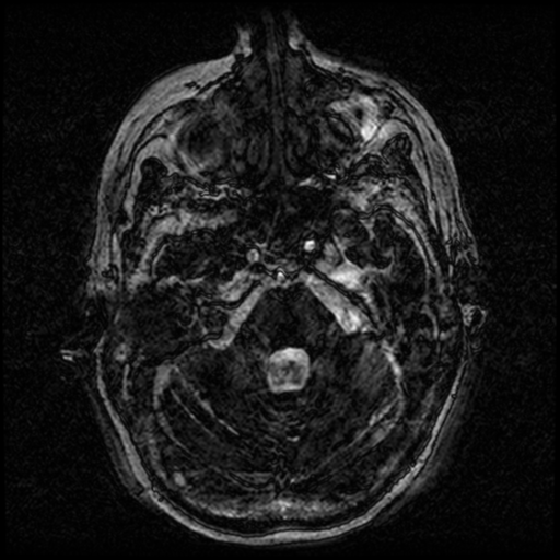 Angioinvasive aspergillosis in the pituitary fossa (Radiopaedia 39676-42010 Ax 3D FIESTA VOLUME 20).png