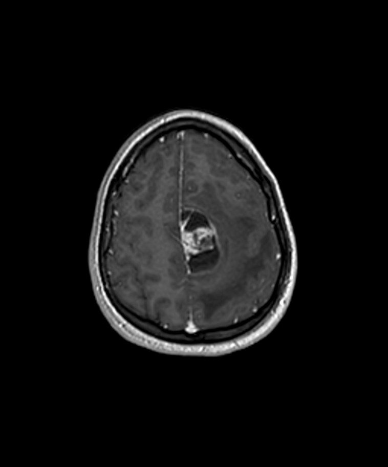Angiomatous meningioma (Radiopaedia 79459-92577 Axial T1 C+ 3D ISO 45).jpg
