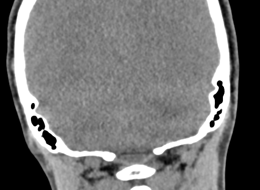 Angular dermoid cyst (Radiopaedia 88967-105790 Coronal non-contrast 98).jpg