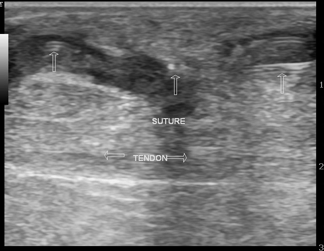 File:Ankle sinus (Radiopaedia 12913-13017 C 1).jpg