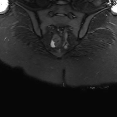 File:Ano-vaginal fistula (Radiopaedia 29765-30284 Coronal STIR 28).jpg