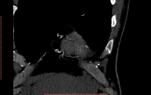 Anomalous left coronary artery from the pulmonary artery (ALCAPA) (Radiopaedia 70148-80181 B 41).jpg