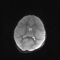File:Anoxic brain injury (Radiopaedia 79165-92139 Axial DWI 14).jpg