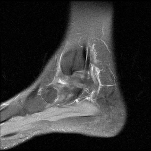 File:Anterior calcaneal process fracture (Radiopaedia 71377-81705 Sagittal PD fat sat 14).jpg
