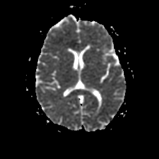 File:Anterior cerebral artery territory infarct (Radiopaedia 39327-41584 Axial ADC 14).png