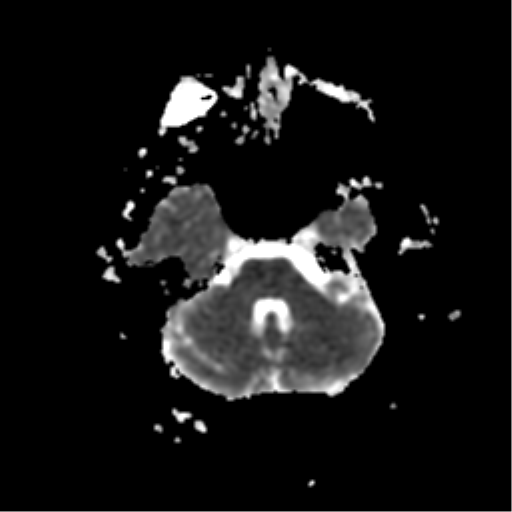 File:Anterior cerebral artery territory infarct (Radiopaedia 39327-41584 Axial ADC 6).png
