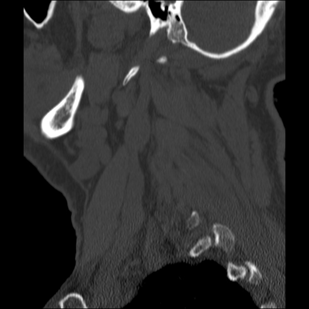 Anterior cervical postdiscectomy arthrodesis (Radiopaedia 32678-33646 Sagittal bone window 71).jpg
