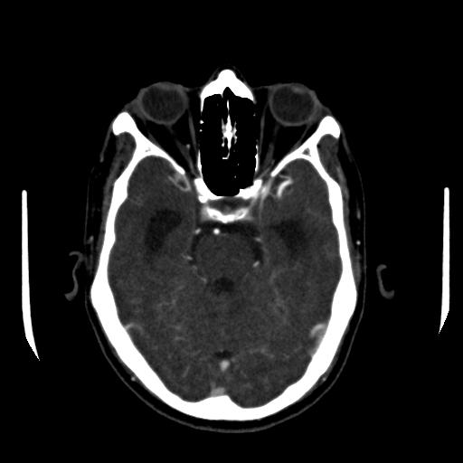 File:Anterior communicating artery aneurysm (Radiopaedia 16633-16335 A 14).jpg