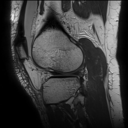 Anterior cruciate ligament rupture with Segond fracture (Radiopaedia 69043-78806 Sagittal PD 138).jpg